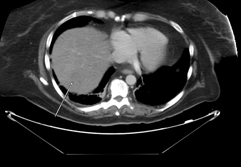FOLLOW-UP 10/2017-4 day h/o persistent nausea and fever CT ABDOMEN & PELVIS Extensive new liver metastases.
