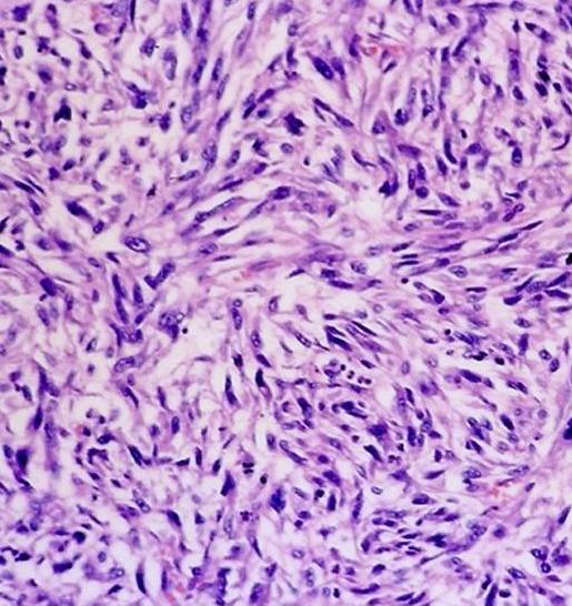Sarcomatoid Malignant Mesothelioma Neoplastic spindle cells in fascicles or sheets Haphazard arrangement Increased mitotic activity,