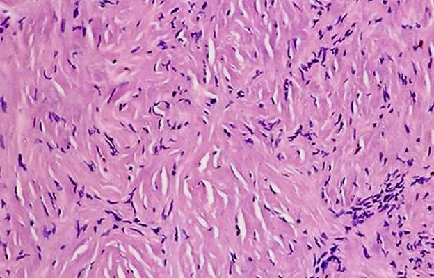Sarcomatoid Malignant Mesothelioma- Desmoplastic Dense collagen in storiform pattern in >50%