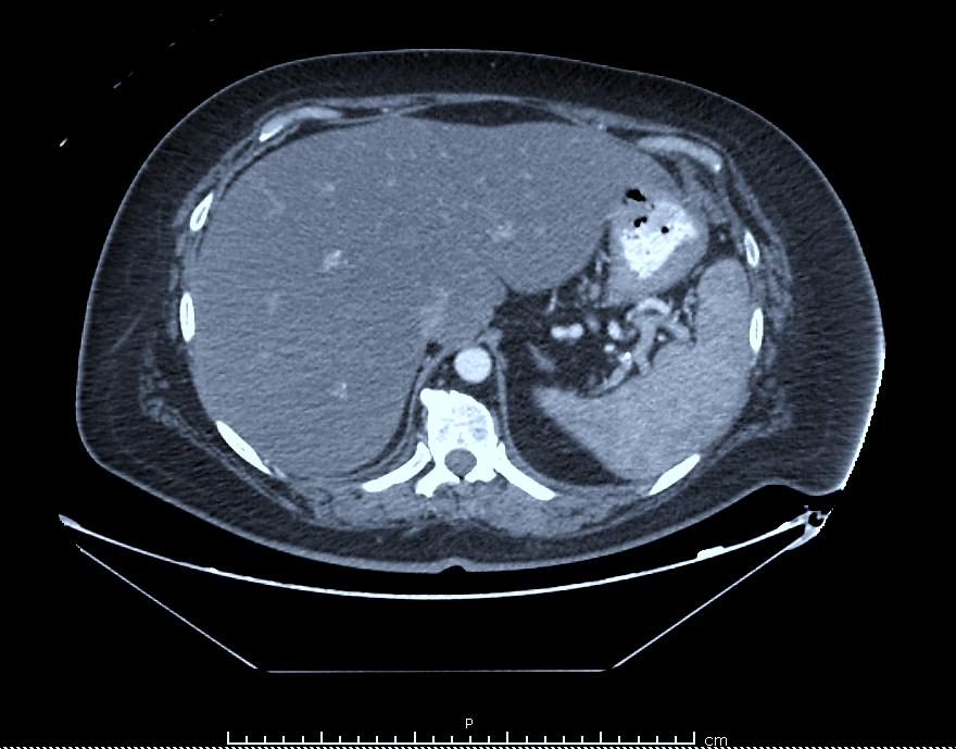 CT ABDOMEN AND PELVIS WITH INTRAVENOUS CONTRAST MASS Orally ingested contrast is seen to reach the colon without obstruction.