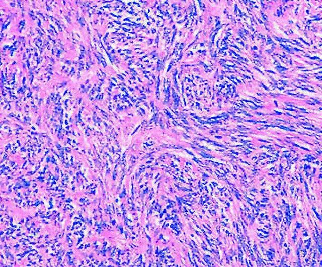 SOLITARY FIBROUS TUMOR PATTERNLESS ARCHITECTURE OF