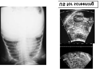 Routine Liver MRI Hemangioendothelioma Variable scout (Ax, Cor, Sag) Coronal, axial T1W Axial T2W fat sat Axial in-phase/out-of-phase Axial dynamic GE image precontrast image HA: 10-15 sec PV: 50-60