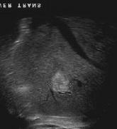 age Large mass with multiple cysts Frank Mitros,