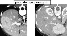 may enhance on delayed images Atypical Hepatic Hemangiomas Focal Nodular