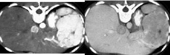 enhancement allows diagnosis Dot sign HA PV Focal Nodular Hyperplasia Focal
