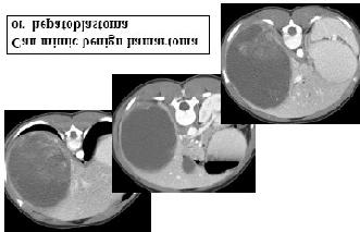 Large tumors (7-20 cm) Myxoid
