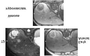 Hepatocellular Carcinoma MR: Fibrolamellar-HCC Arterial Phase Portal venous