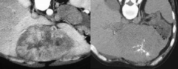 yrs Well-defined mass»central scar»calcifications Secondary Liver Neoplasms