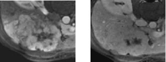 Neuroblastoma Rhabdomyosarcoma Lymphoma Fibrolamellar HCC (HCC Variant)