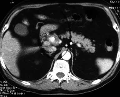 # Ruptured hepatic artery aneurysm # In the postoperative period, the alanine and aspartate transaminase levels were elevated to 1607 U/L and >3000 U/L, respectively.