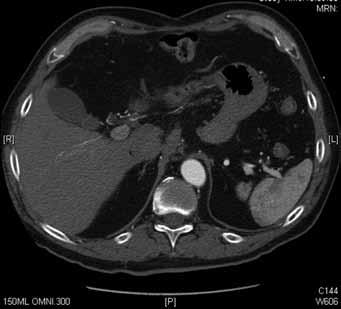 Follow-up CT performed at and 8 months postoperatively showed arterial collateral formation along the porta hepatis, and there was no evidence of previous liver infarction (Figs 1b and 1c).