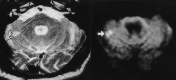 A B C Fig. 3. A 75 year-old male patient was admitted due to right side motor weakness and global aphasia. The initial neurologic deficits were fully recovered after 1 hour.
