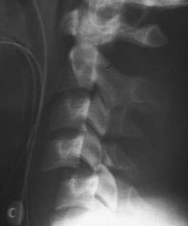 Bilateral Facet Dislocation Vertebral body displaced at least 50%