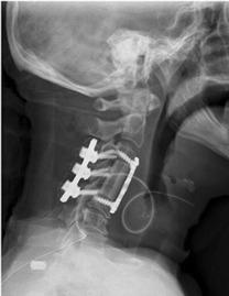 Bilateral Facet Dislocation Definitive treatment requires surgical stabilization - Anterior decompression and