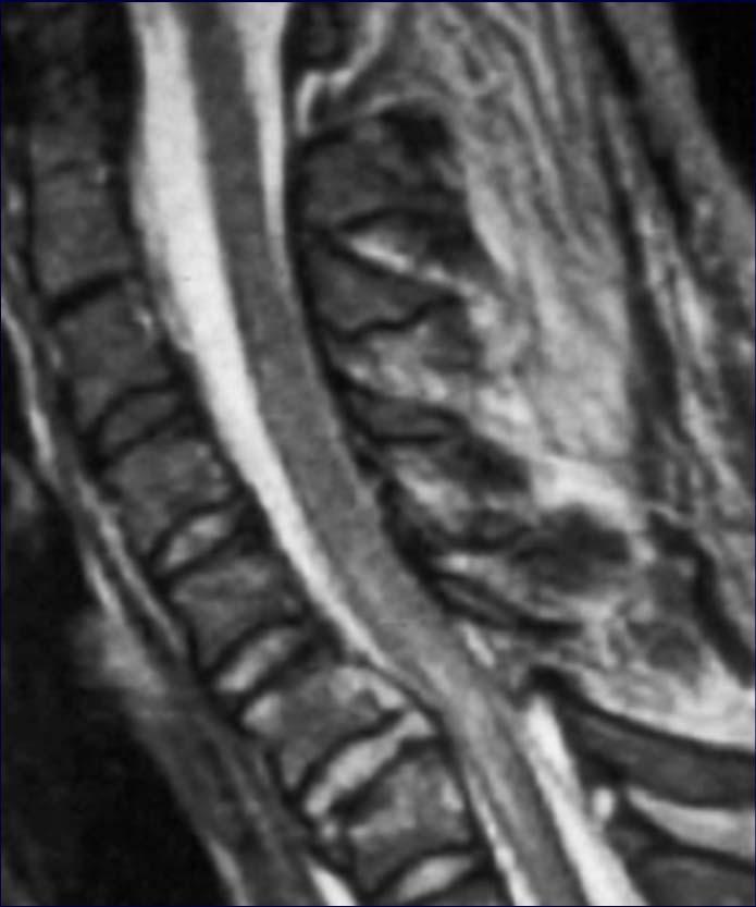 Cervical Fractures in DISH or Ankylosing Spondylitis C6/7 fracture in DISH
