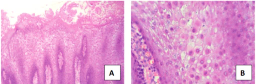 White sponge nevus in the oral cavity: case report and Figure 2.