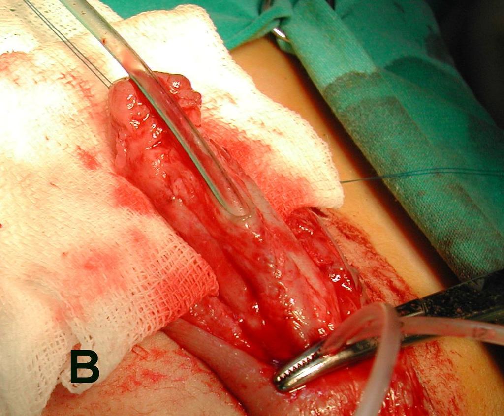 Subsequently, the buccal mucosa graft was placed on the prepared bed and fixed in place by 7.0 monocryl sutures.
