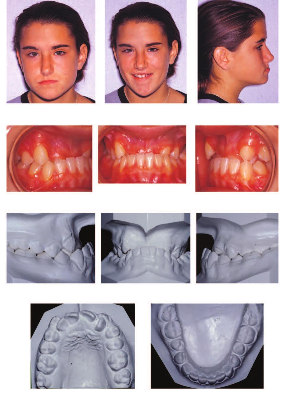 Clinical Figure 1: Pre-treatment facial photographs. Figure 2: Pre-treatment intraoral photos.