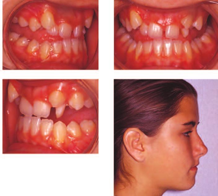 Figure 5: Pre-treatment centric relation. of attached tissue on the lower anterior teeth. Oral hygiene was considered adequate. There were no sign of any dental decay or other pathology.
