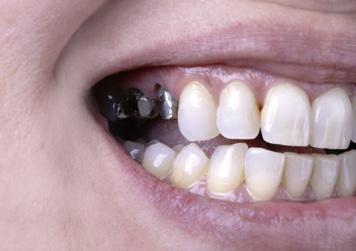 Teeth 14 + 15: impressive zirconia restoration with HeraCeram