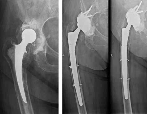 EArLy COMPLICAtIOnS AFtEr revision total HIP ArtHrOPLASty 359 table II.
