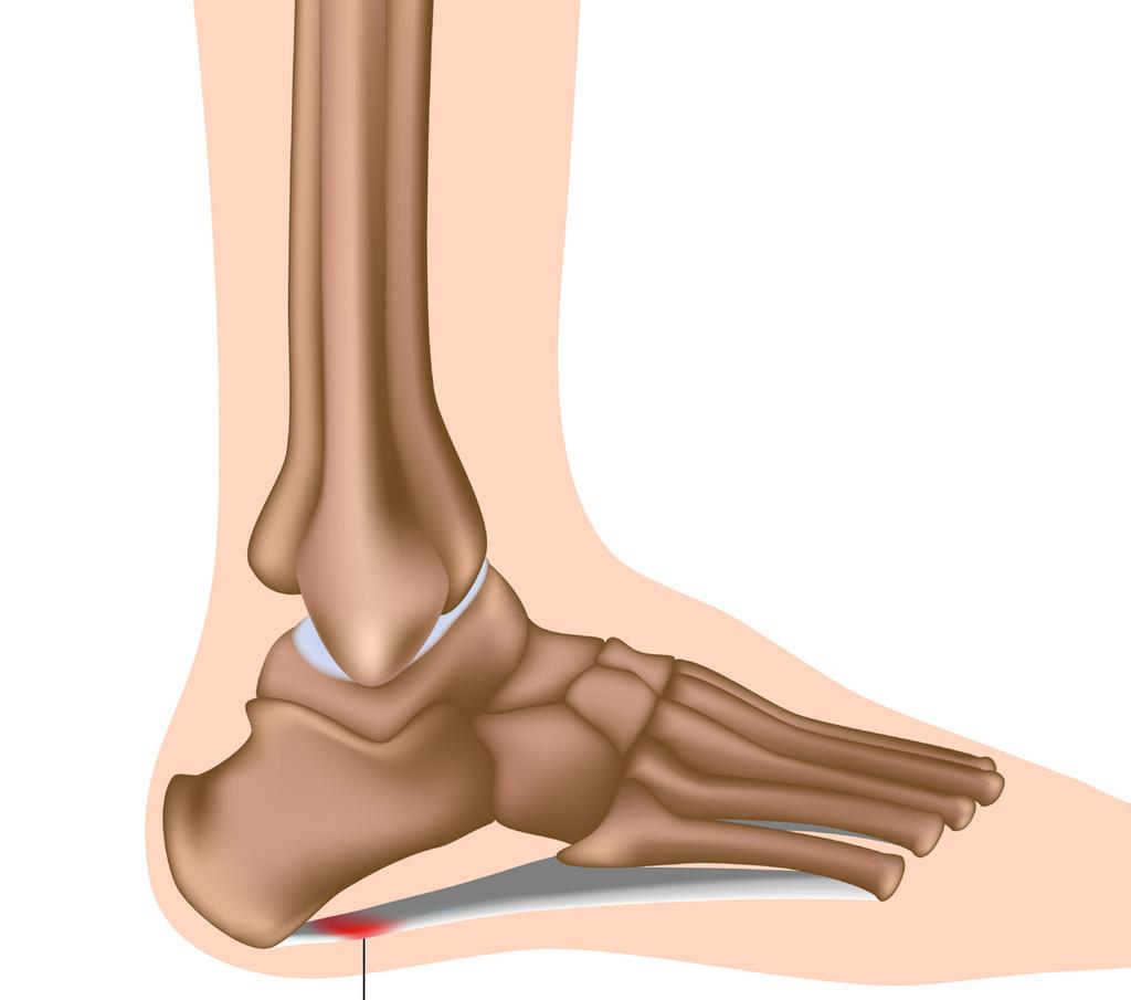 Injury of the week - Plantar Fasciitis Running underneath the foot from the bottom of the heel bone to the toes, is a long fibrous tissue known as fascia.