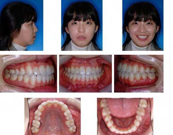 Guidelines for Surgery First Orthodontic Treatment 275 Fig. 8. Final Presentation. The total treatment time in surgery first cases is reduced.