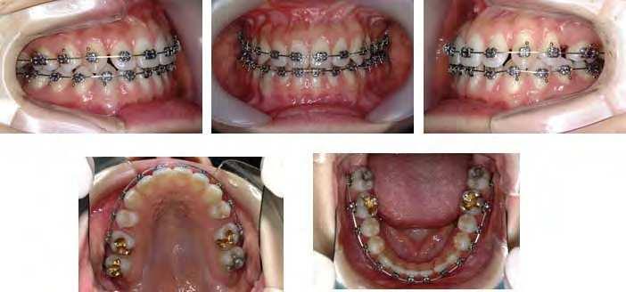 15. Initiation of orthodontic