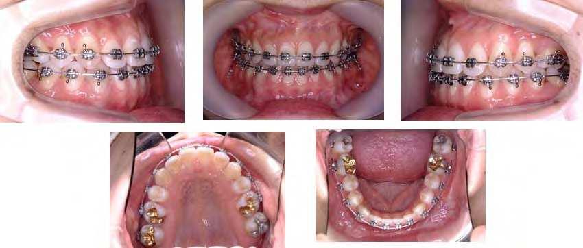 Orthodontic Treatment in