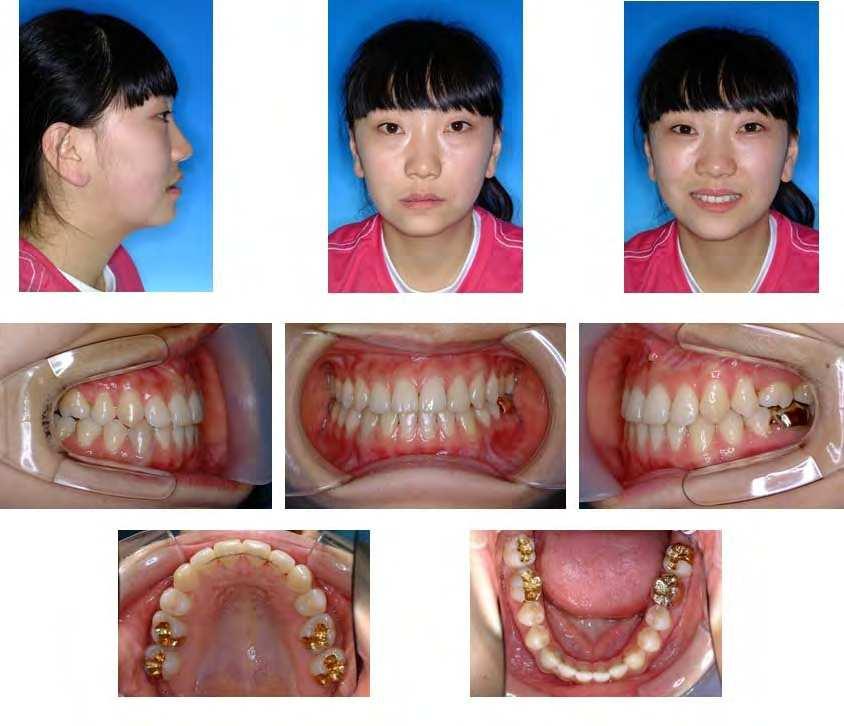 284 Orthodontics Basic Aspects and Clinical Considerations Case was debonded after 16 months of active orthodontics. Figure 17 shows the final records with good occlusion and esthetics. Fig. 17. Final Records.