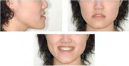 Guidelines for Surgery First Orthodontic Treatment 287 orthodontist s vision on what is achievable post orthodontically based on previous experience.