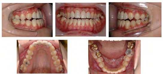 By utilizing the temporary anchorage devices, many orthodontists try to have a back-up system which can be used to help in post-surgical orthodontic phase.