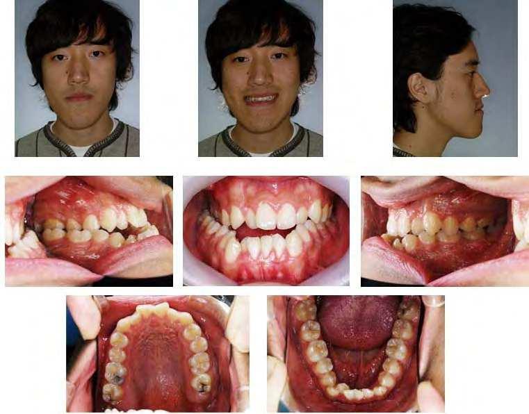 Guidelines for Surgery First Orthodontic Treatment 295 expansion
