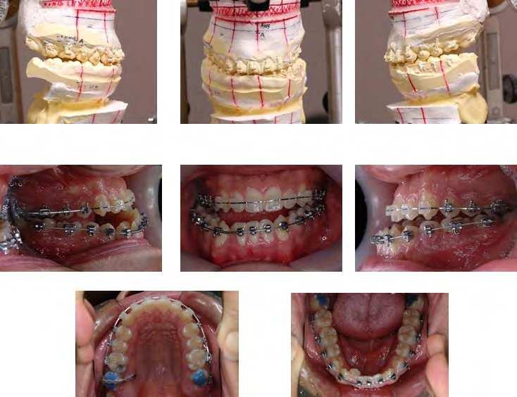296 Orthodontics Basic Aspects and Clinical Considerations The upper right second molar required a significant amount of buccal root torque in preparation of surgery.