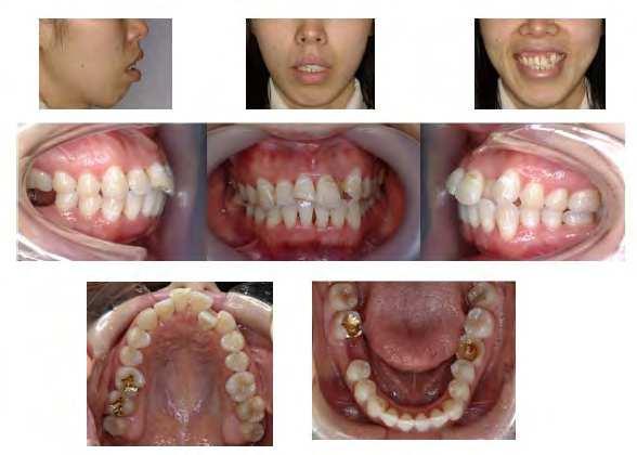 Guidelines for Surgery First Orthodontic Treatment 269 premolars were extracted at the time of surgery and the anterior dentoalveolar segments were set back before any orthodontic treatment was