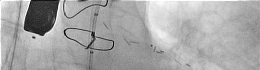 Access Right Radiale artery puncture
