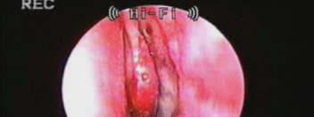 Lingual tonsillectomy
