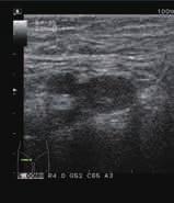 B Cross sectional view of the right inguinal area in a patient with deep venous thrombo sis affecting