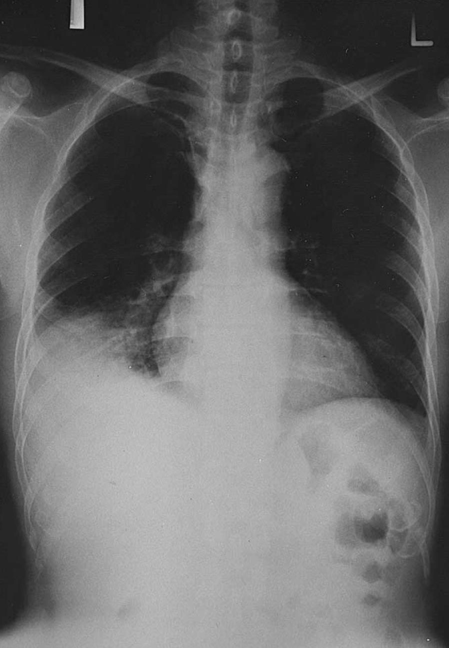 Case 12 Pneumonia