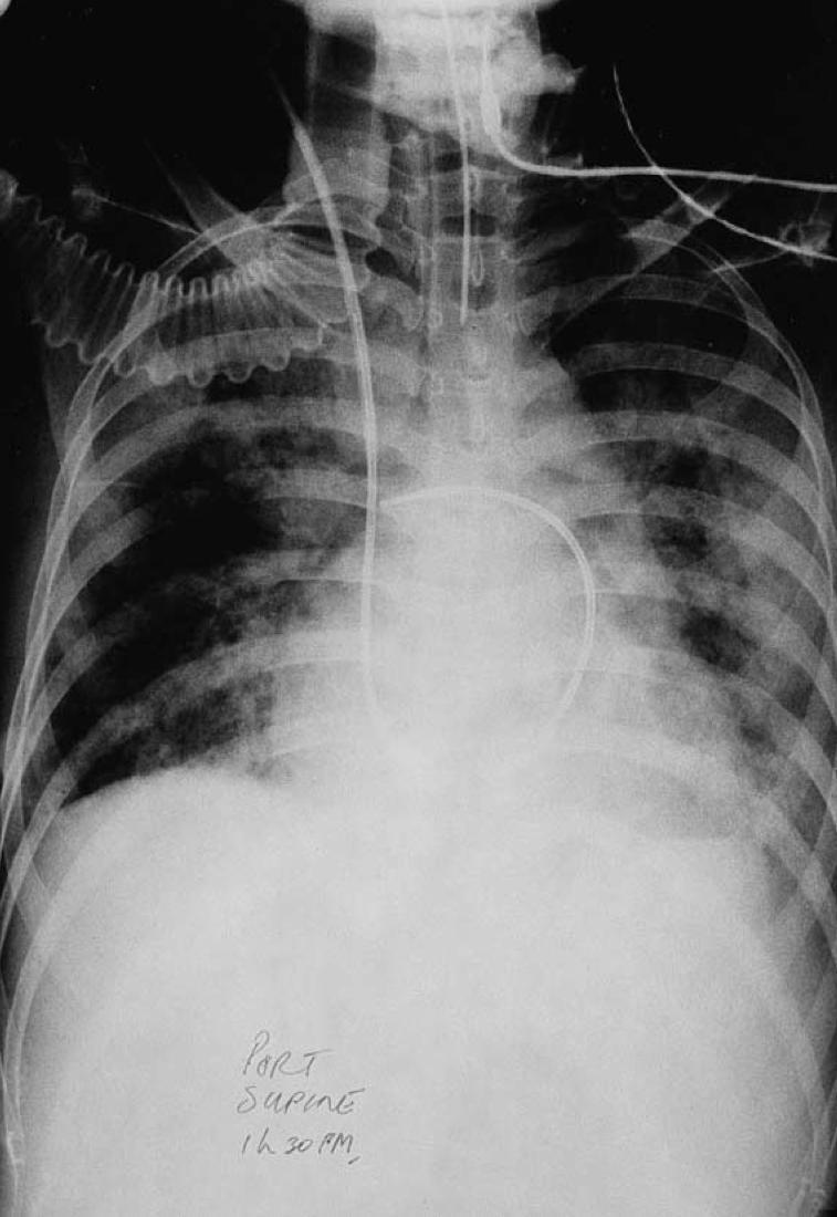 Case 24 Displaced Pulmonary