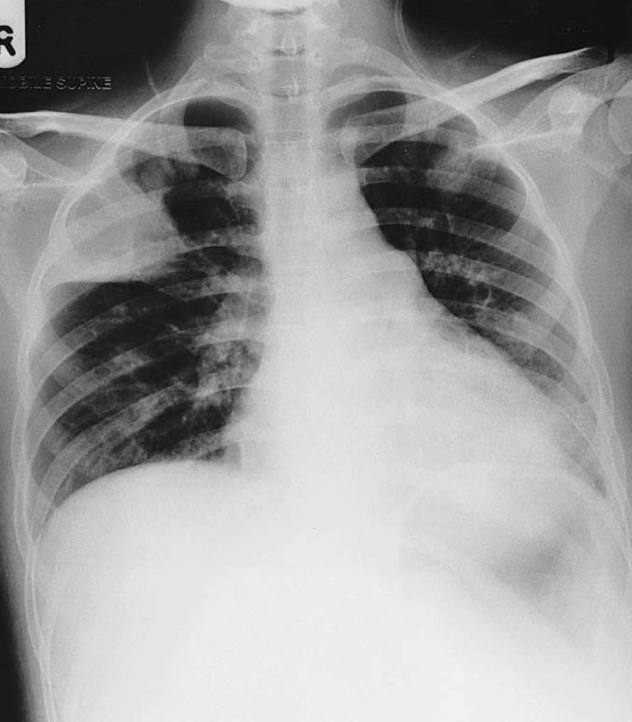 Case 30 AML with Pulmonary