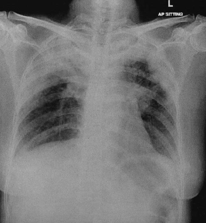 Case 41 Chronic Eosinophilic Pneumonia