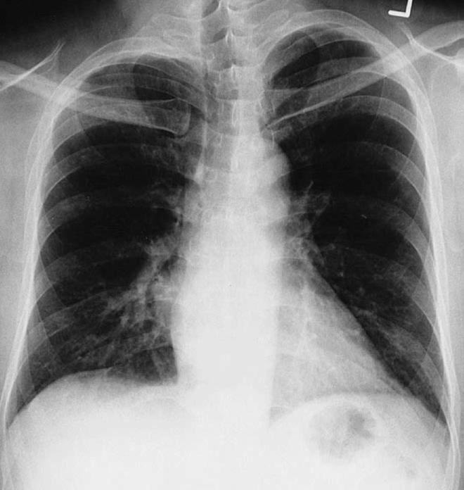 Case 63 Lung