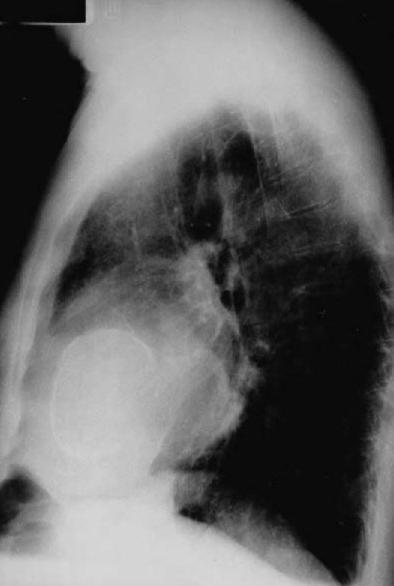 Case 65 Calcified Left