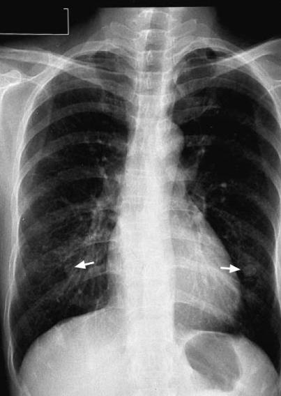 Case 72 - Pulmonary