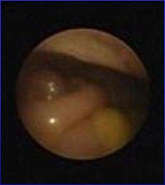 Purpose of viewing peritoneum through the peritoneoscope: * confirm intraperitoneal position
