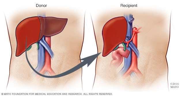 LIVER TRANSPLANTATION Male patient Age : 58 years