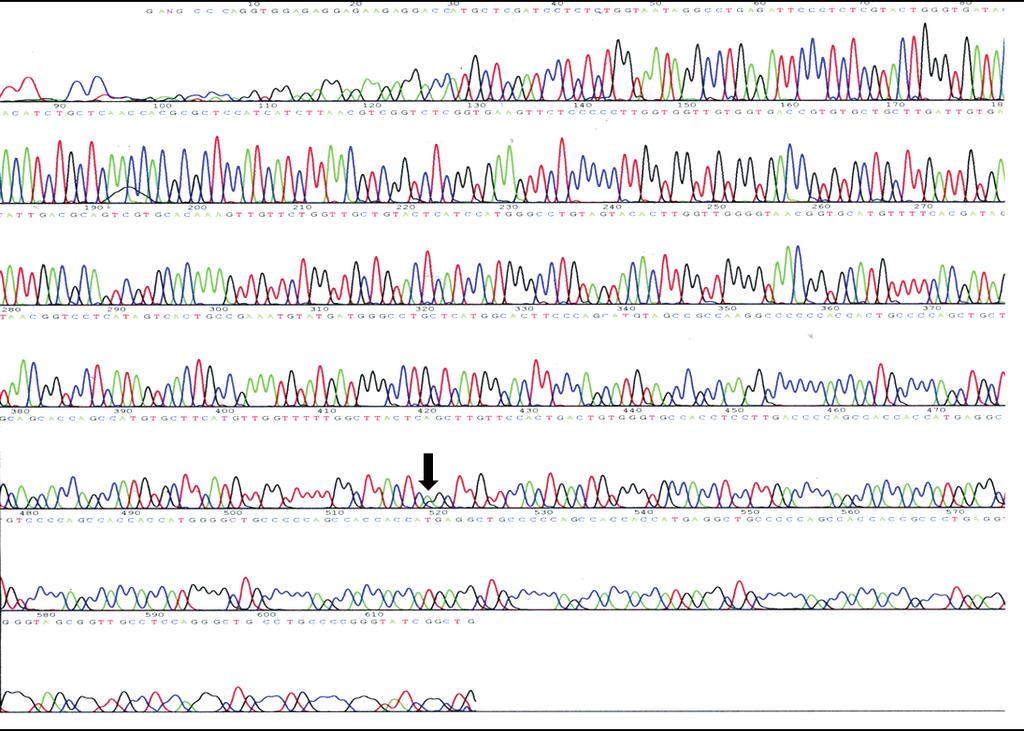 Park MJ et al. Fig. 4. Sequencing data of PRNP. Arrow indicates a proline (CCG)-to-leucine (CTG) mutation in codon 102. PRNP: prion protein gene. 3-3 protein can also be helpful.