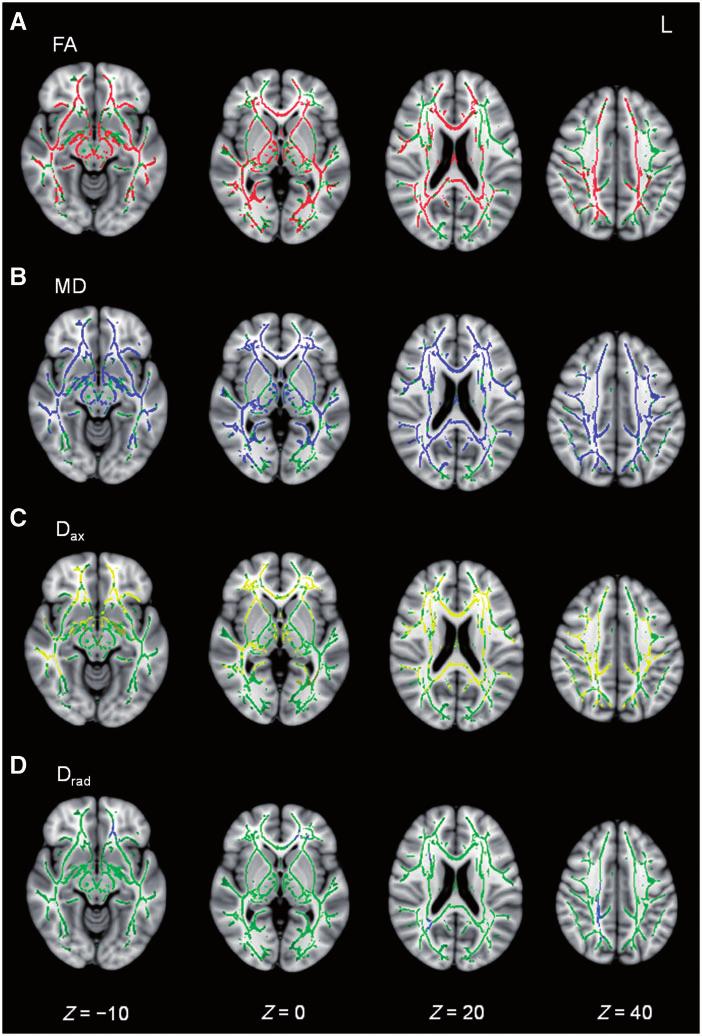 454 Brain 2011: 134; 449 463 K. M. Kinnunen et al. Figure 2 Widespread white matter disruption following traumatic brain injury.