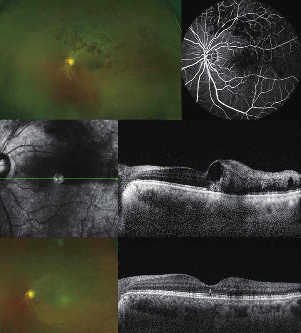 JOURNAL OF RETINA A B A B C C D E D E Figure 1. A representative case from the responder group. A man in his early sixties presented with vision loss in his left eye.